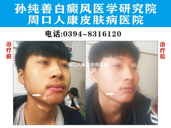 完全型白癜风都有什么症状?