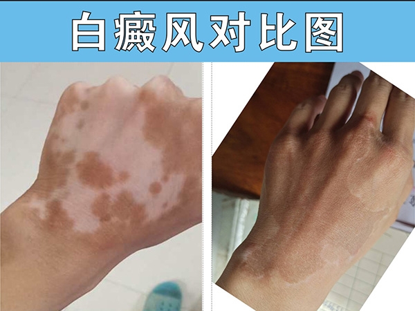 周口白癜风
