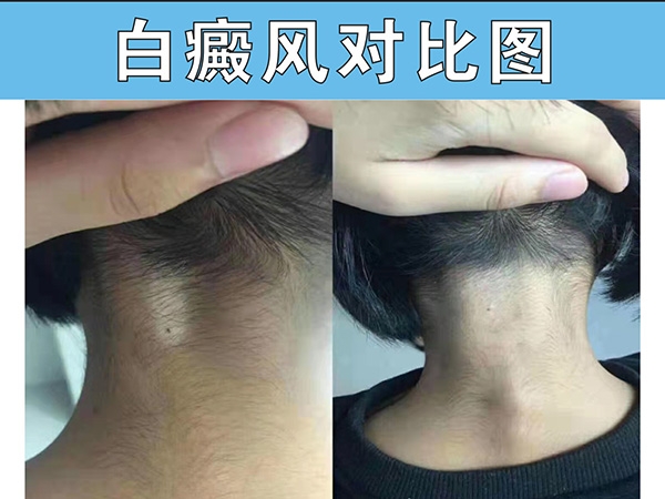 周口白癜风治疗